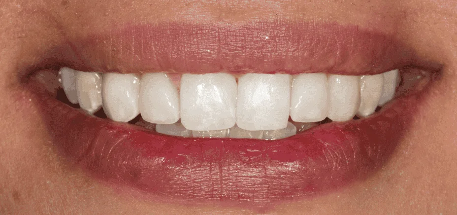 3 E.max veneers, after