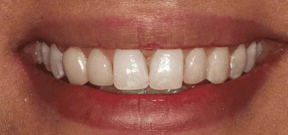 3 E.max veneers, before