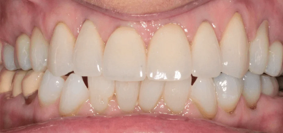 E.max & zirconia crowns, after