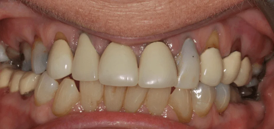 E.max & zirconia crowns, before
