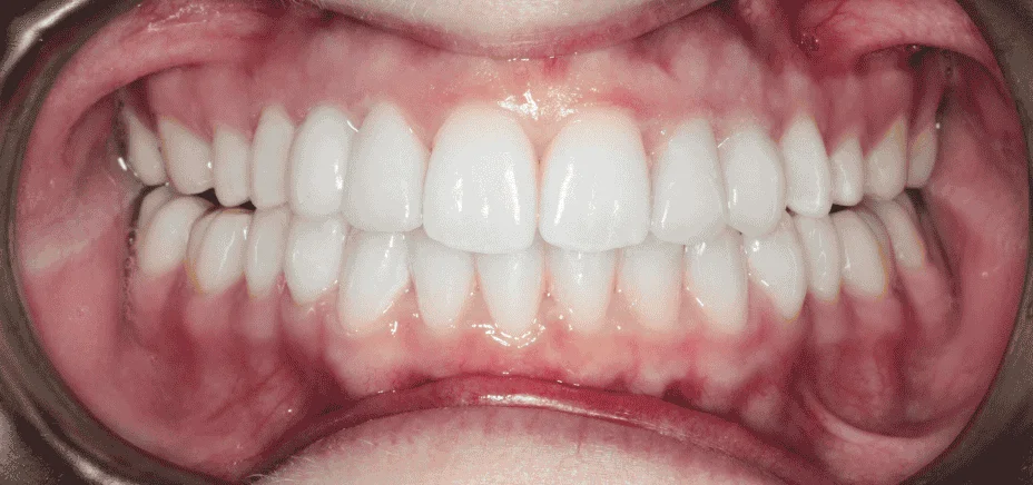 Invisalign & bonding — retained baby teeth, after