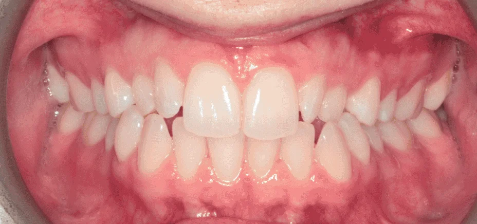 Invisalign & bonding — retained baby teeth, before