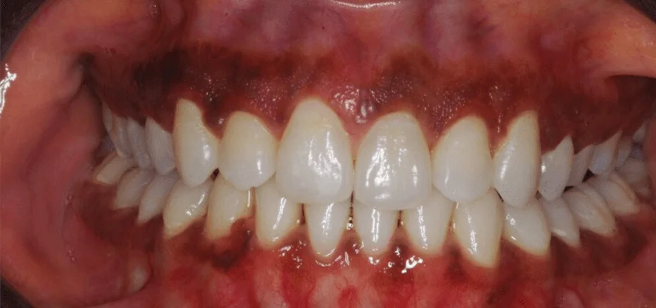 Invisalign space closure, after