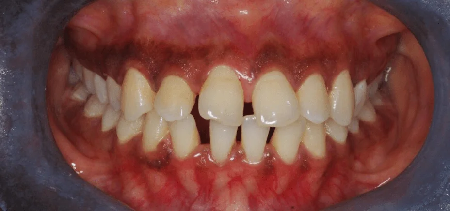Invisalign space closure, before