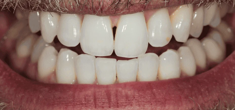Whitening, after