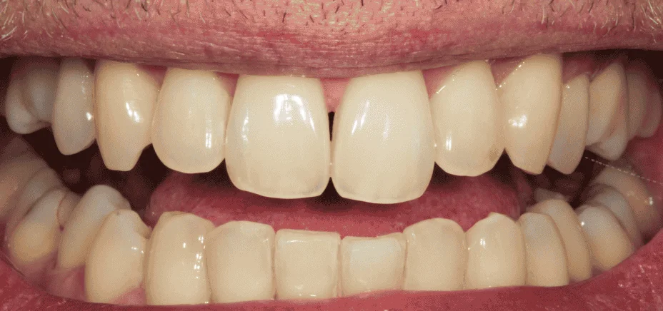 Whitening, before