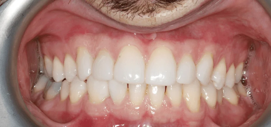 Composite bonding — soft look, after