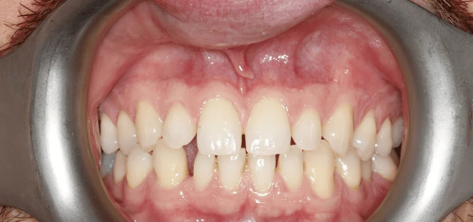 Composite bonding — soft look, before