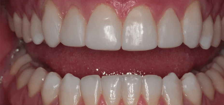 Composite bonding — square look, after