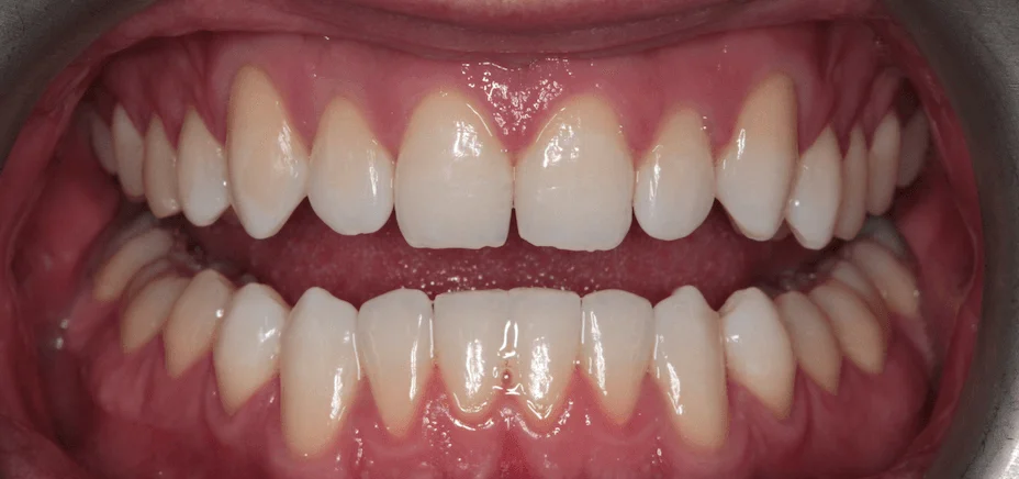Composite bonding — square look, before